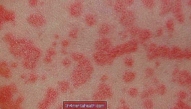 Kuinka päästä eroon amoksisilliini-ihottumasta - allergia
