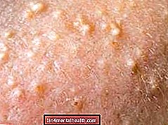 Was sind diese weißen Flecken auf meiner Haut? - Allergie