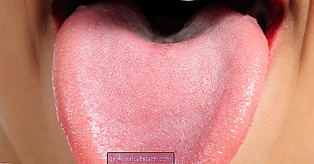 Какво може да причини петна по езика?