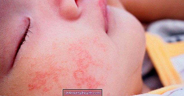Mitä tehdä, jos vauvalla on allerginen reaktio - allergia
