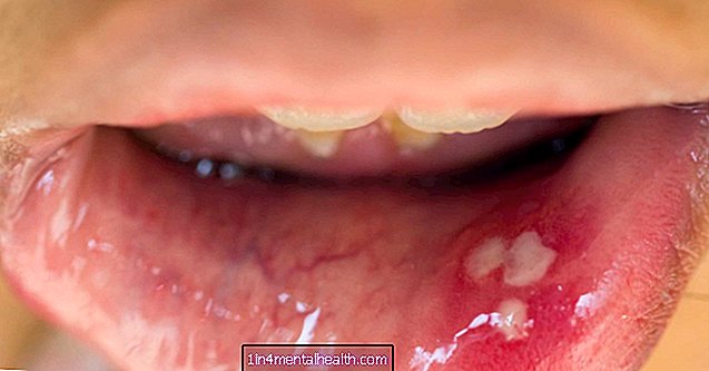 Wie sieht HPV in Ihrem Mund aus? - Geburtenkontrolle - Empfängnisverhütung