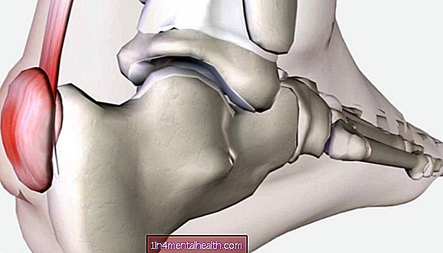 ¿Cómo se trata la deformidad de Haglund? - huesos - ortopedia