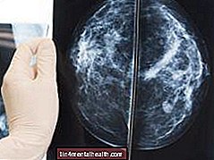 삼중 음성 유방암에 대해 알아야 할 사항 - 유방암