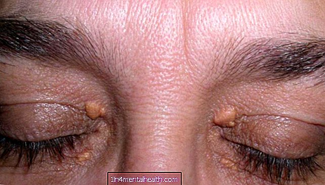 Cholesterinablagerungen in den Augen: Symptome und Behandlung - Cholesterin