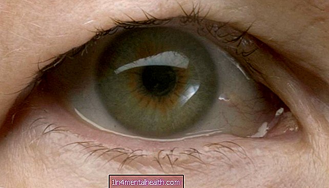 Hvordan behandler du et hengende øyelokk? - kosmetisk medisin - plastikkirurgi