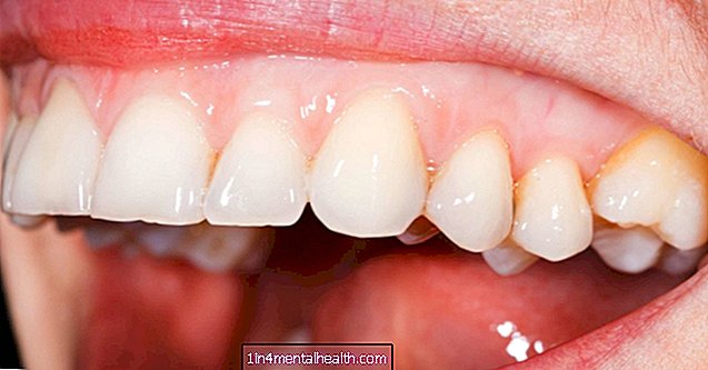 Mikä aiheuttaa vaaleat ikenet? - hammaslääketiede