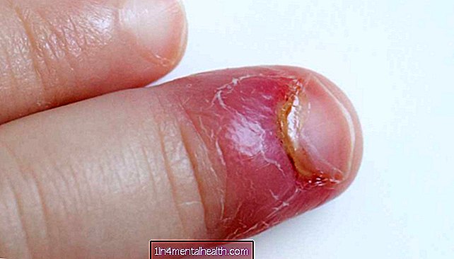 Cum se tratează paronichia (o unghie infectată) - dermatologie