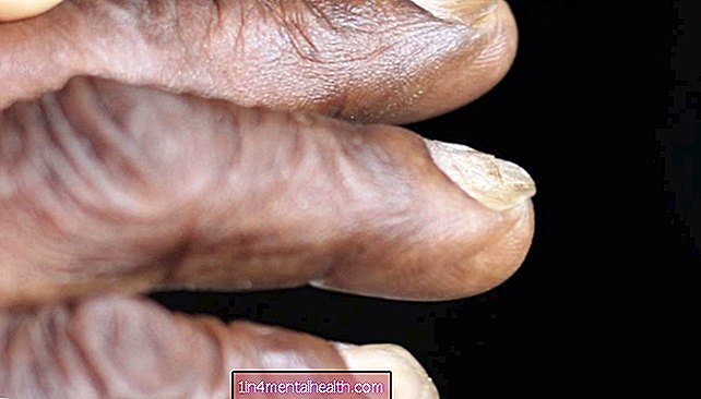 Koilonychia: Hvorfor er mine negle skeformede?