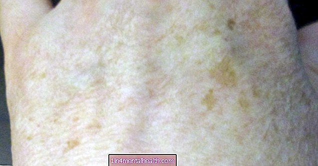 Ce trebuie făcut cu privire la pigmentare - dermatologie