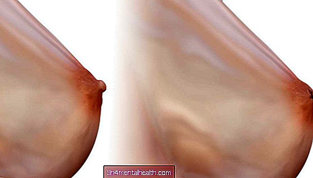Hvad man skal vide om omvendte brystvorter - dermatologi
