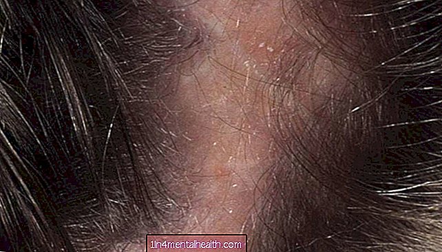 Was Sie über Infektionen der Kopfhaut wissen sollten - Dermatologie