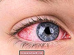 Mikä on kuiva silmä ja miten voin päästä eroon siitä? - kuiva silmä