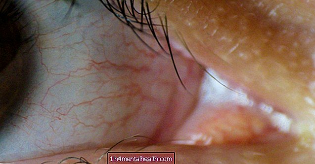 Mitä tietää punctal-pistokkeista kuivasilmäisille - kuiva silmä
