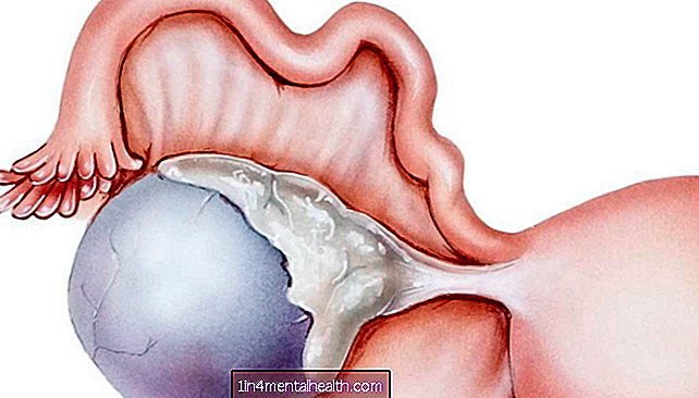Hva å vite om komplekse cyster på eggstokkene - endometriose