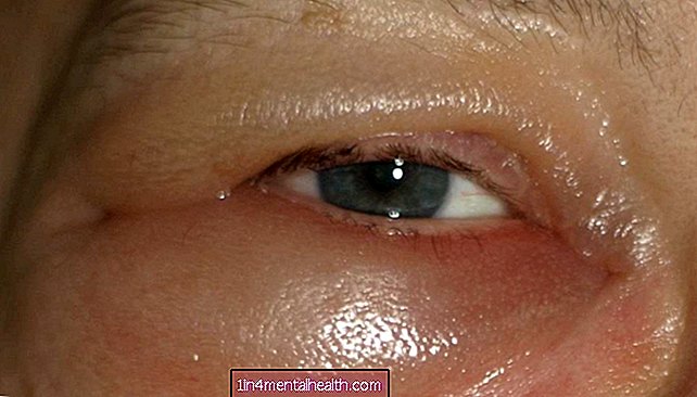 Hvordan blir du kvitt oppblåste øyne? - øyehelse - blindhet