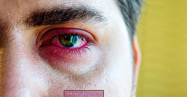 ¿Qué puede causar dolor en los párpados? - salud ocular - ceguera