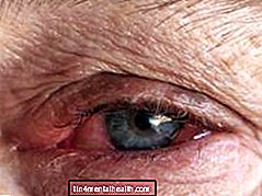 ¿Qué es la conjuntivitis infecciosa o conjuntivitis? - salud ocular - ceguera