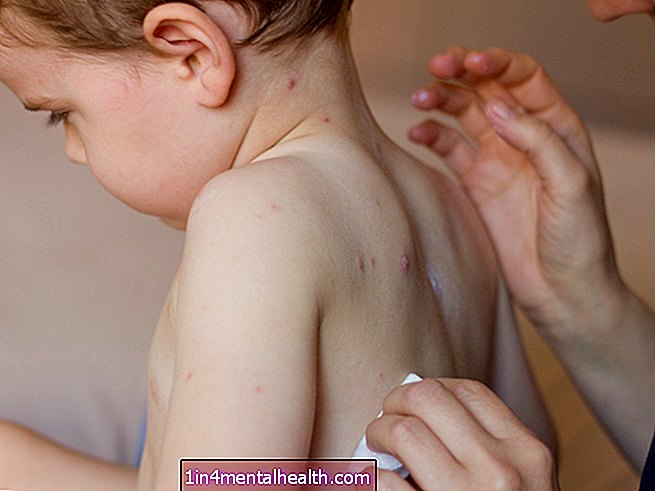 Mida leetrite kohta teada - immuunsüsteem - vaktsiinid