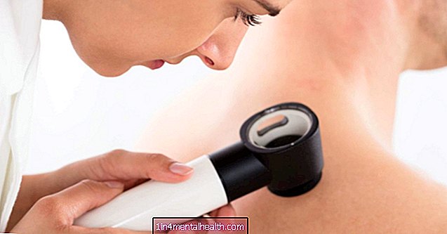 Kaalulangus vähendab nahavähi riski - melanoom - nahavähk