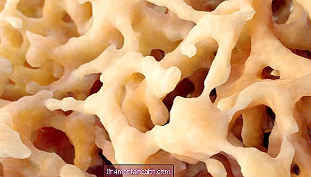 Osteoporoza crește riscul de demență - osteoporoză