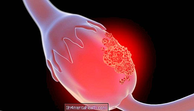 Cáncer de ovario: los científicos encuentran una manera de lanzar un ataque dual - cáncer de ovarios
