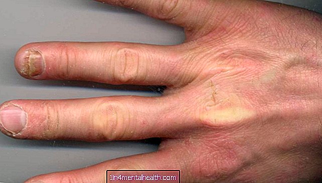 ¿Cómo afecta la artritis psoriásica a las uñas? - soriasis