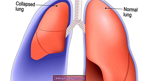Lo que debe saber sobre un pulmón perforado - sistema pulmonar