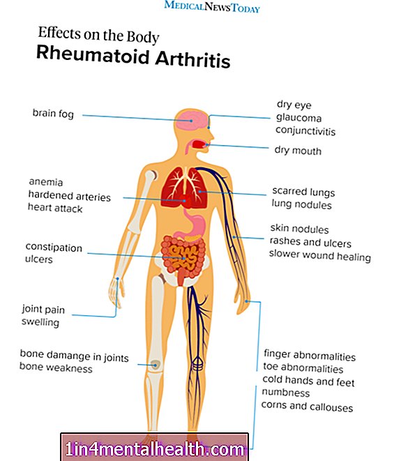Millised on reumatoidartriidi sümptomid? - reumatoidartriit