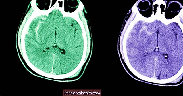 Hva du bør vite om subaraknoidalblødning - hjerneslag